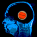 Ballon de basket dans un cr�ne